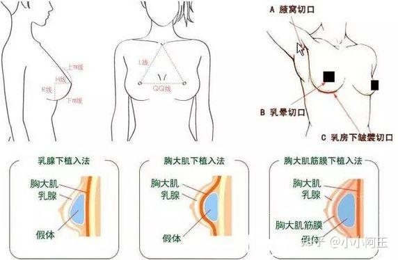 北京做隆胸手术的费用分析
