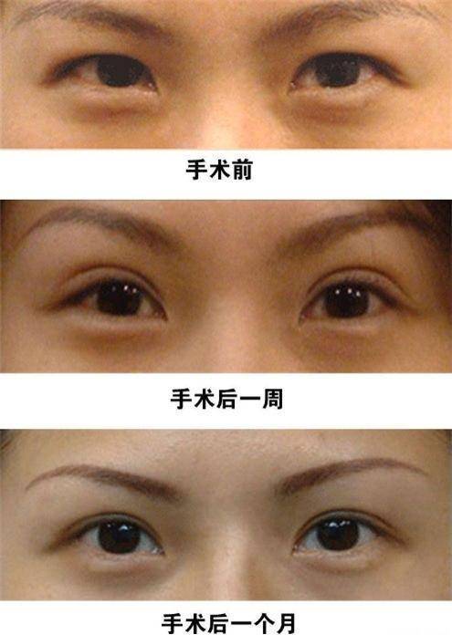 北京双眼皮手术，专业解析与全面指南