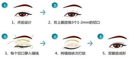 眼睛整形价格，全面解析与理解