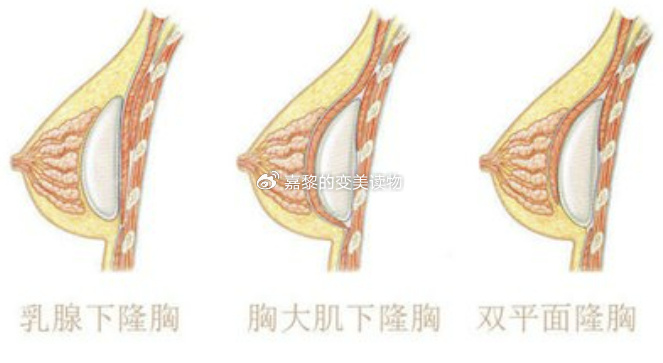 上海隆胸手术，现代美容外科的精湛技艺