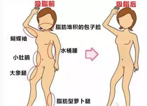 北京吸脂，专业吸脂手术及其相关知识解析