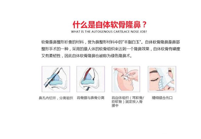 自体软骨隆鼻的价格因素及深度解析