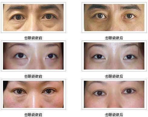 眼袋修复价格，全面解析眼部美容手术费用