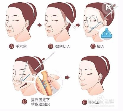 手术除皱多少钱，全面解析除皱手术费用及其相关因素