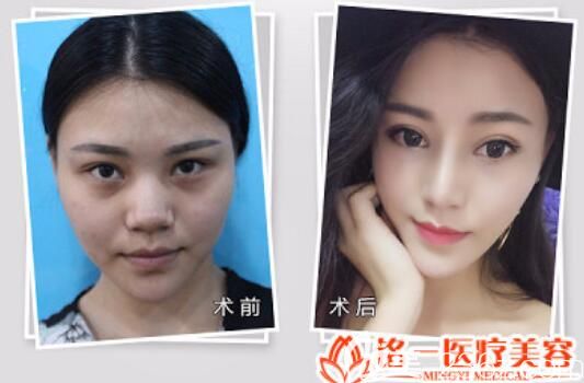 隆鼻价格