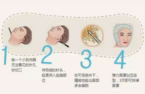 面部吸脂价格，全面解析费用因素与选择策略