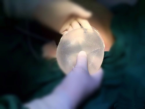 隆胸价格是多少，全面解析丰胸手术费用因素