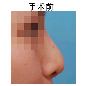 注射隆鼻价格