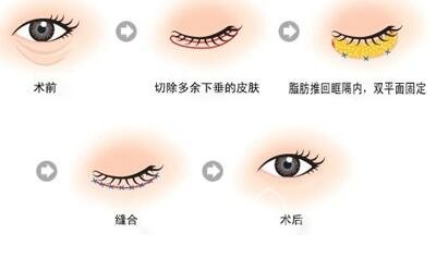 揭秘去眼袋手术费用，了解价格背后的因素