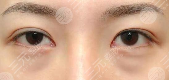 激光去眼袋价格