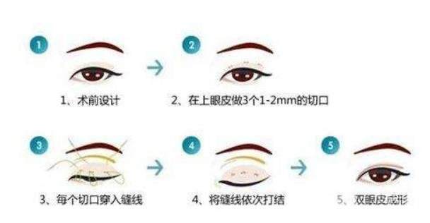 韩式双眼皮手术费用全面解析，多少钱才能实现美丽梦想？